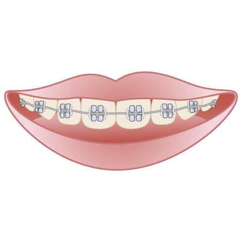 マルチブラケット(表側矯正・唇側矯正)